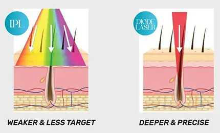 Introducing the ND Yag Alexandrite Laser Machine: Revolutionizing Precision and Efficiency in Modern Medicine