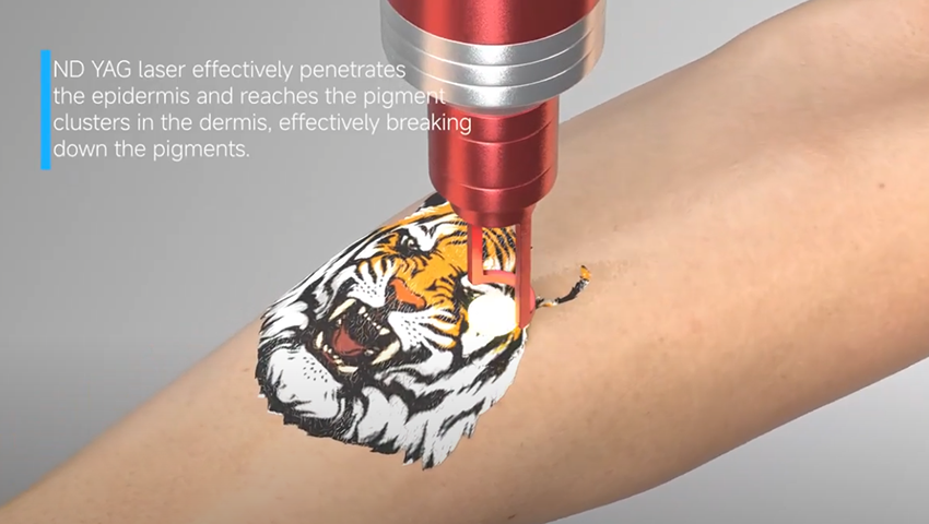 Diode Laser+ND YAG Laser Portable  BV Laser 5 subscribers Analytics Edit video